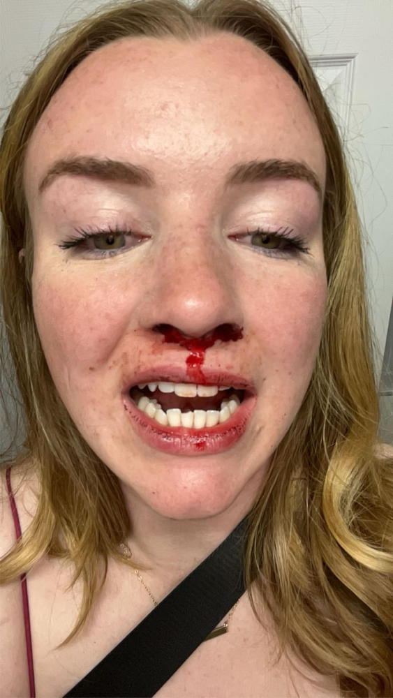 a woman's face with a bloody nose